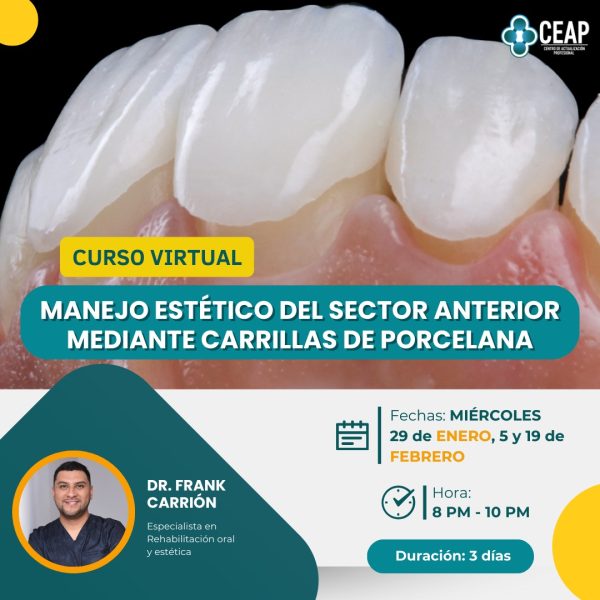 Curso Manejo Estético del sector anterior mediante carillas de porcelana